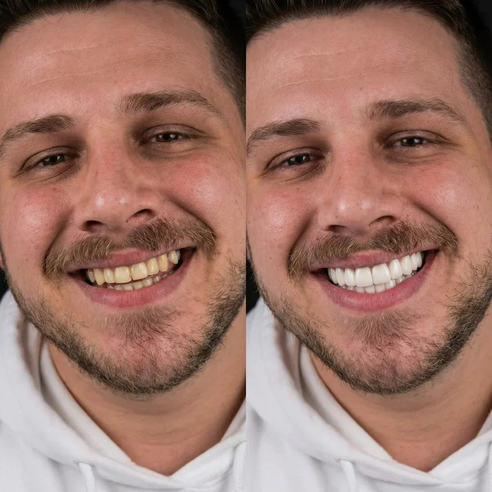 LUMÉ™ SmileForm Diş Seti